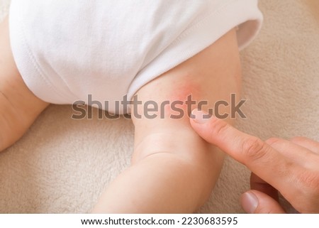 Young adult mother finger pointing to newborn leg with red rash. Allergy from milk formula or mother milk. Baby skin problem. Closeup. Top view. Royalty-Free Stock Photo #2230683595