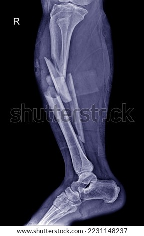 X-RAY image of the tibia and an oblique fracture of the fibula