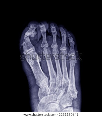 
X-ray picture of the broken toe bone dislocated or dislocated from a serious foot accident. This causes the ligaments that hold the bones and joints in the foot torn.