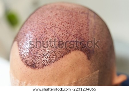 Detail of hair line after hair transplant surgery to cure baldness at clinic Royalty-Free Stock Photo #2231234065