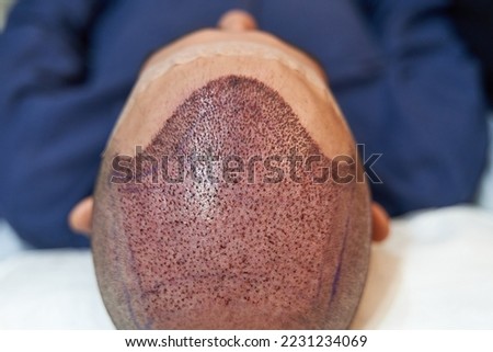 Detail of scalp of male lying down after hair transplant surgery Royalty-Free Stock Photo #2231234069