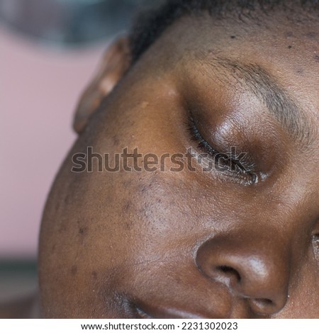 Brown skin with dark spots, hyperpigmentation on brown skin, african american woman with skin blemishes, imperfect skin Royalty-Free Stock Photo #2231302023