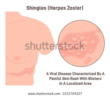 Shingles. Herpes zoster, viral disease with skin rush with stripe of blisters appearance. Flat vector illustration Royalty-Free Stock Photo #2231704227