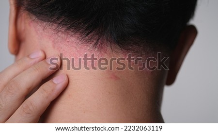 psoriasis on the nape of a man. skin with psoriasis. Royalty-Free Stock Photo #2232063119