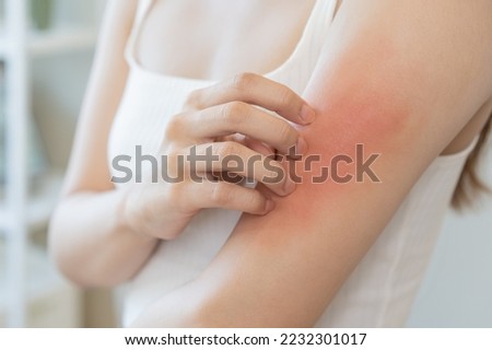 Dermatology asian young woman, girl allergy, allergic reaction from atopic, insect bites on her arm, hand in scratching itchy, itch red spot or rash of skin. Healthcare, treatment of beauty. Royalty-Free Stock Photo #2232301017