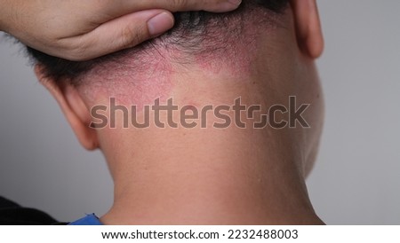 psoriasis on the nape of a man. skin with psoriasis. Royalty-Free Stock Photo #2232488003