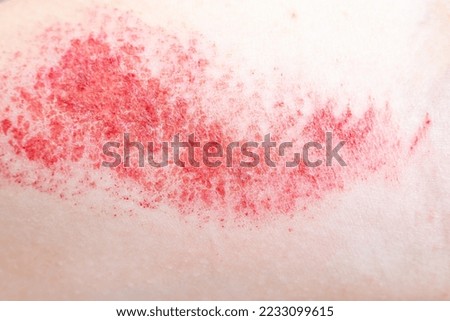 Children's hand burn. Children's hand with a burnt wound on a white background.Close up Royalty-Free Stock Photo #2233099615
