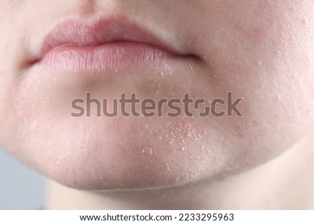 Woman with dry skin on face against light grey background, closeup Royalty-Free Stock Photo #2233295963