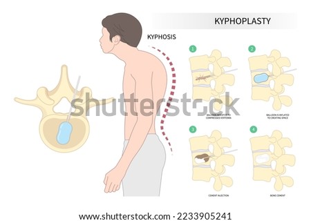back and neck pain hunched bone posture with kyphoplasty spine of dowager’s hump disease disk joint surgical degeneration over backbone vertebral column Royalty-Free Stock Photo #2233905241