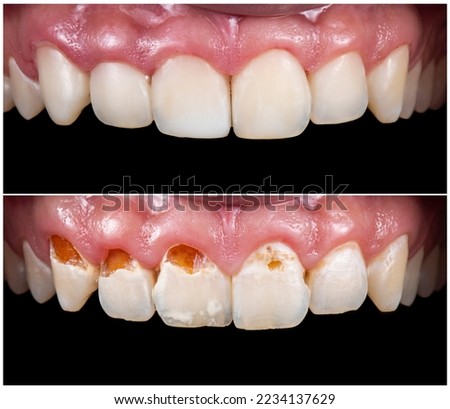 dameged teeth composite restoration before and after picture