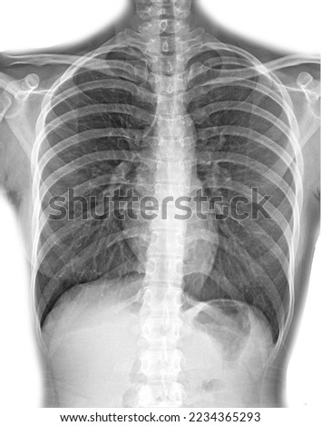  chest X-ray PA upright in white background