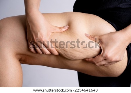 Cellulite leg woman pinch. Test fat hips treatment. Over weight liposuction.  Royalty-Free Stock Photo #2234641643