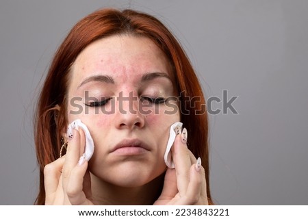 Caucasian girl taking off her makeup with make-up remover wipes. Facial redness due to nickel allergy contained in cosmetic products. Allergy and urticaria concept Royalty-Free Stock Photo #2234843221
