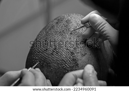 Hair transplantation with dhi technique. Fue Hair Transplant Follicular Unit Extraction Operation. Royalty-Free Stock Photo #2234960091