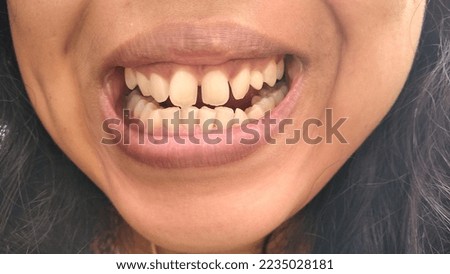 Close up of human teeth and gap between front teeth. Crooked teeth in women