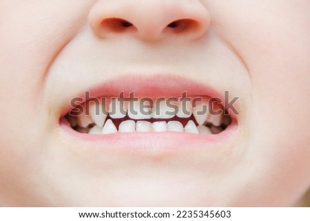 Caries in children's teeth. Initial stage. Close-up. Black spotted milk teeth. A common symptom of fluorosis and tooth decay in children Royalty-Free Stock Photo #2235345603