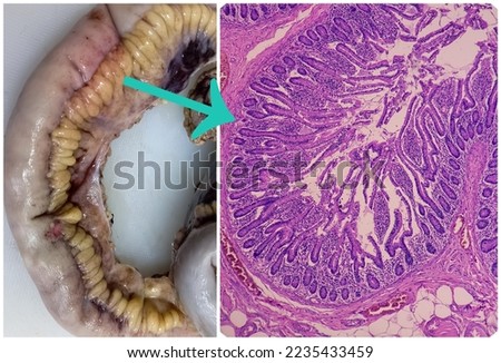 Transverse colon(biopsy): Colon and microscopic image, Fibromatosis. spindle cells with bland nuclei, collagen, infiltration of inflammatory cells. Royalty-Free Stock Photo #2235433459