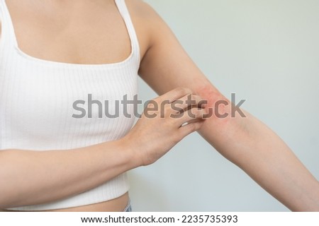 Dermatology asian young woman, girl allergy, allergic reaction from atopic, insect bites on her arm, hand in scratching itchy, itch red spot or rash of skin. Healthcare, treatment of beauty. Royalty-Free Stock Photo #2235735393