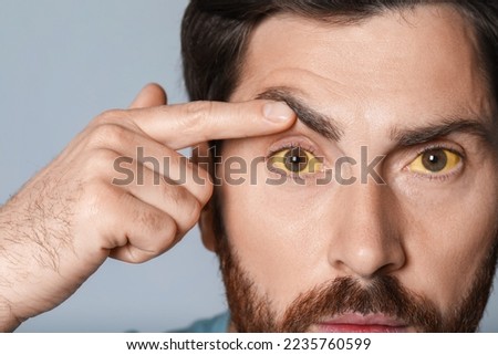 Man with yellow eyes on grey background, closeup. Symptom of hepatitis Royalty-Free Stock Photo #2235760599