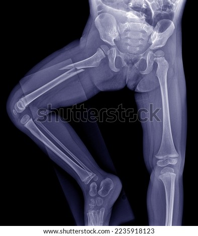 X-ray images of the pelvis and thigh bones as ordered by your doctor. An oblique fracture of the femur was found. Royalty-Free Stock Photo #2235918123