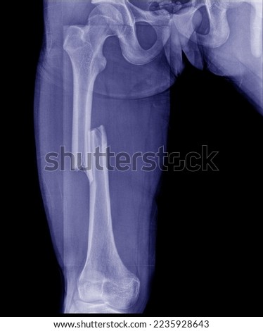 X-ray images of the femur showed a central fracture. Royalty-Free Stock Photo #2235928643