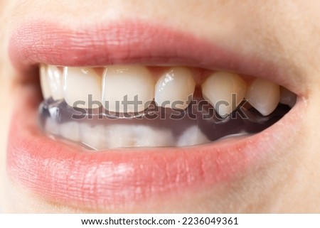 Dental mouthguard, splint in the mouth for the treatment of dysfunction of the temporomandibular joints, bruxism, malocclusion, to relax the muscles of the jaw Royalty-Free Stock Photo #2236049361