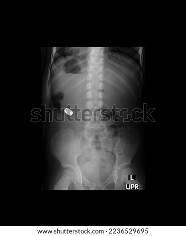 Child Abdomen with foreign body  Royalty-Free Stock Photo #2236529695