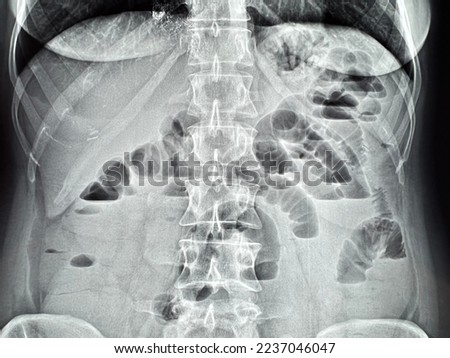 x-ray acute intestinal obstruction, intestinal arches Royalty-Free Stock Photo #2237046047