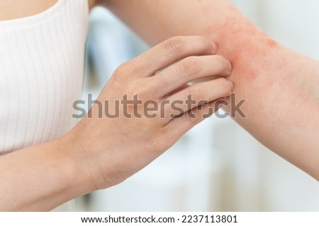 Sensitive skin allergic concept, Woman itching on her arm have a red rash from allergy symptom and from scratching. Royalty-Free Stock Photo #2237113801