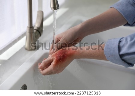 Woman holding hand with burn under flowing water indoors, closeup Royalty-Free Stock Photo #2237125313