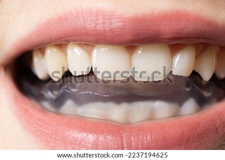Dental mouthguard, splint in the mouth for the treatment of dysfunction of the temporomandibular joints, bruxism, malocclusion, to relax the muscles of the jaw. Royalty-Free Stock Photo #2237194625