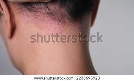 psoriasis on the nape of a man. skin with psoriasis. Royalty-Free Stock Photo #2238695923