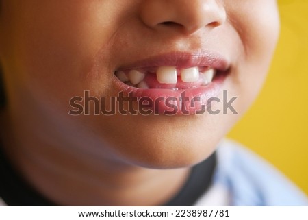 child girl with deformed teeth  Royalty-Free Stock Photo #2238987781