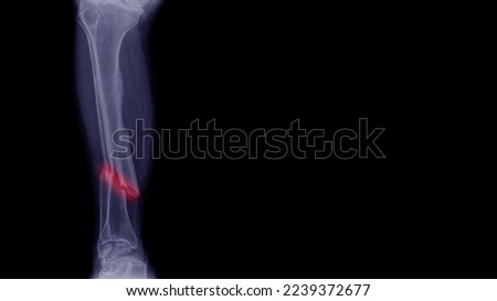 
X-ray image of leg with distal fracture oblique split Royalty-Free Stock Photo #2239372677