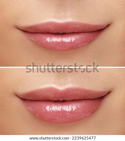 Women lips correction before and after comparison. Hyaluronic acid injection. Beauty lip treatment procedure.  Royalty-Free Stock Photo #2239625477