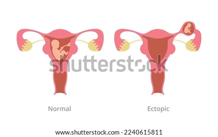 ectopic pregnancy pregnancy problem with comparison with normal pregnancy with modern flat style Royalty-Free Stock Photo #2240615811