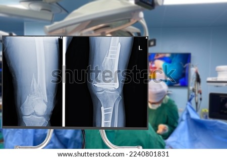 x-ray of leg and knee. Blurry Traumatology orthopedic surgery hospital emergency operating room for the leg broken operation. Medical health and Education concept.  Royalty-Free Stock Photo #2240801831