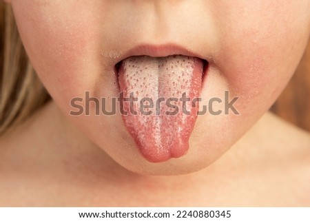 Strawberry tongue of a small child with scarlet fever caused by group A streptococcus Royalty-Free Stock Photo #2240880345