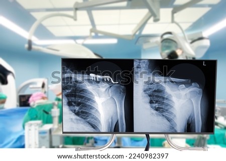 X-ray clavicle bone fracture is treated by surgery and plate fixation(ORIF) Blurry Traumatology orthopedic surgery hospital operating room for the bone operation. Medical health and Education concept Royalty-Free Stock Photo #2240982397