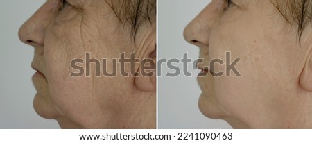 Elderly woman face wrinkles before and after treatment Royalty-Free Stock Photo #2241090463