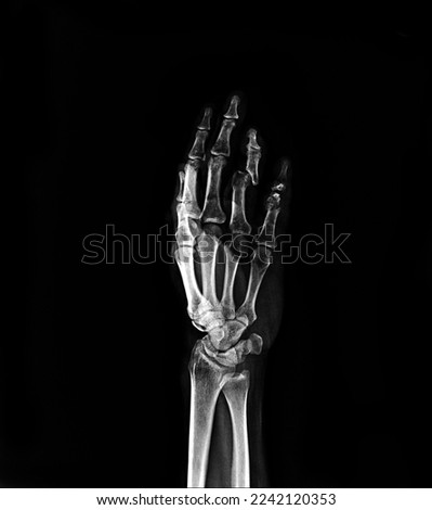 Film x-ray fracture ring finger and Fracture little finger . Film x-ray AP