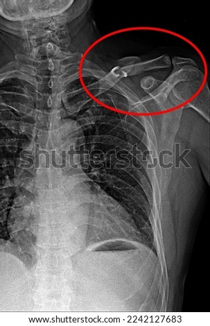 Film x-ray clavicle  AP show fracture clavicle bone in the red circle Royalty-Free Stock Photo #2242127683