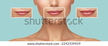 Comparison of a Women lips correction before and after Hyaluronic acid injection.Beauty lip treatment procedure.  Royalty-Free Stock Photo #2242339459