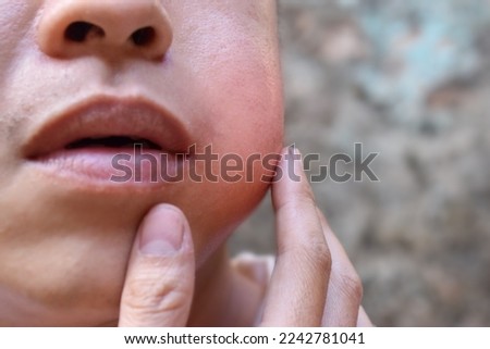 Swelling at the cheek of Asian young man. Inflammation of parotid gland called parotitis. Mumps. Royalty-Free Stock Photo #2242781041