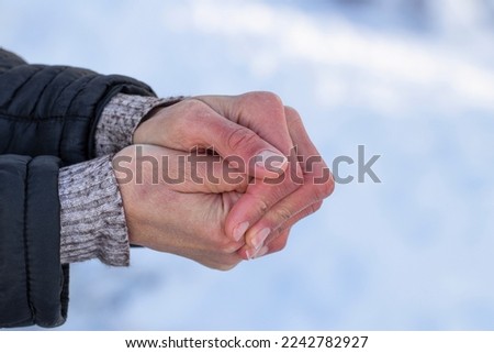 Women's frozen hands in the cold.Women's hands with dry skin and red fingers in the cold in winter.The concept of skin care in winter. Royalty-Free Stock Photo #2242782927
