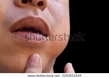 Swelling at the cheek of Asian young man. Inflammation of parotid gland called parotitis. Mumps. Royalty-Free Stock Photo #2242812649