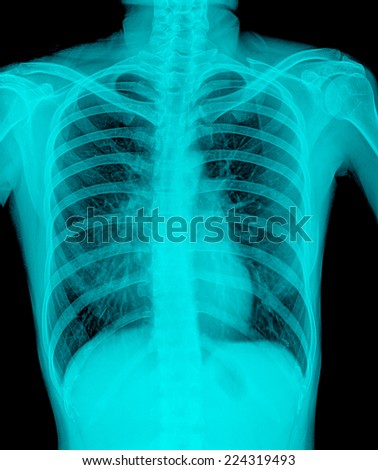X-Ray Image Of Human Chest - TB screening