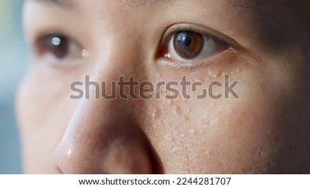 Syringoma milia milium cysts or seborrheic keratosis on asia people female face body care. Close-up young adult asian woman under eye small acne liver spot skin issue smile with pride look at camera. Royalty-Free Stock Photo #2244281707