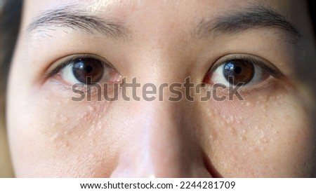 Syringoma milia milium cysts or seborrheic keratosis on asia people female face body care. Close-up young adult asian woman under eye small acne liver spot skin issue smile with pride look at camera. Royalty-Free Stock Photo #2244281709