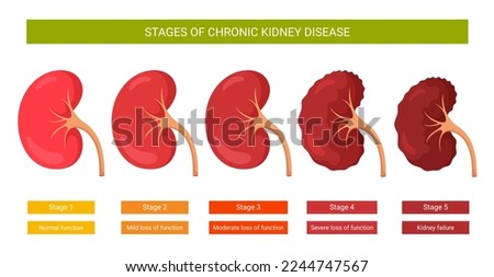 Infographics stages of chronic kidney disease Royalty-Free Stock Photo #2244747567